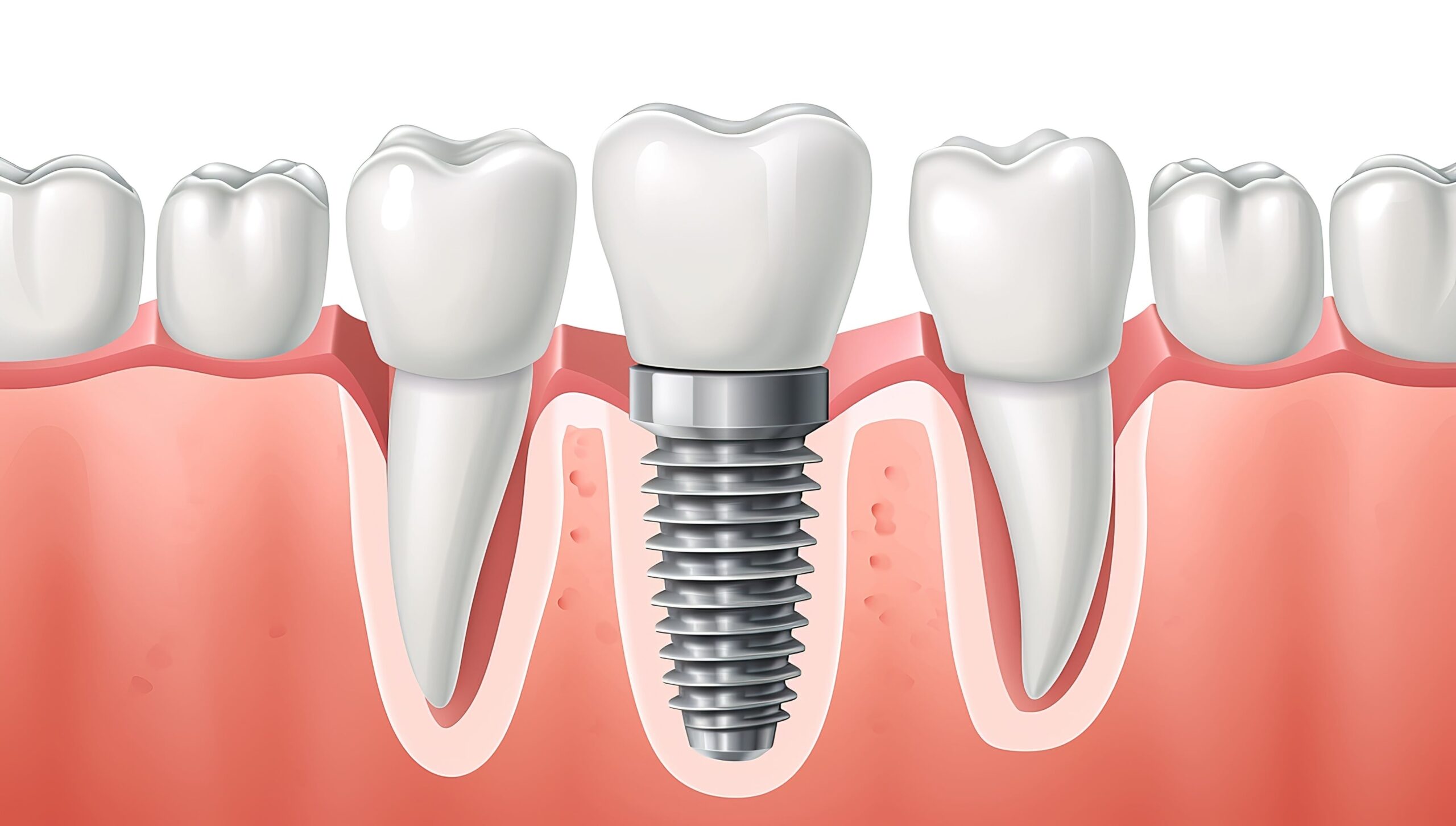Dental Implants