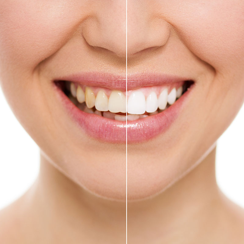 Dental Esthetic/Whitening